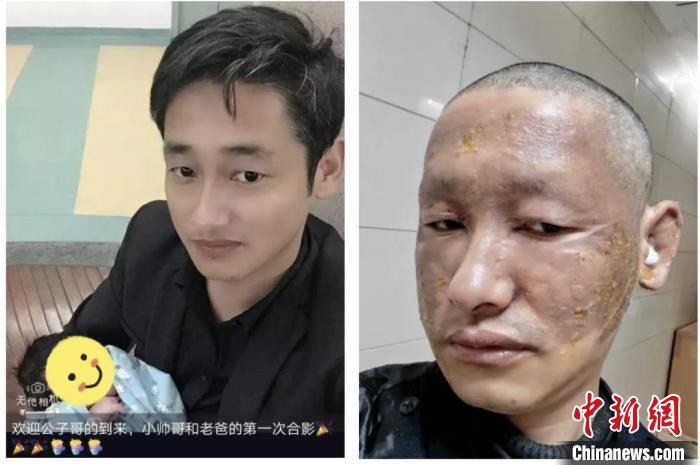 Yao Senlin, an auxiliary police officer, was compared before and after being burned. Photo courtesy of Yao Senlin Yao Senlin, an auxiliary police officer, was compared before and after being burned. Photo courtesy of Yao Senlin